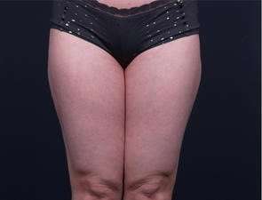 Liposuction Before & After Patient #1513