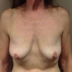 Breast Mastopexy Before & After Patient #221