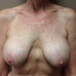 Breast Mastopexy Before & After Patient #228