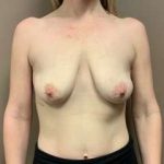 Breast Mastopexy Before & After Patient #340