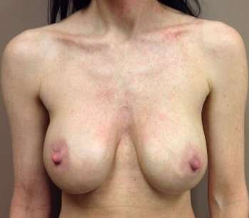 Breast Mastopexy Before & After Patient #345