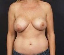 Breast Implant Revision Replacement Before & After Patient #364