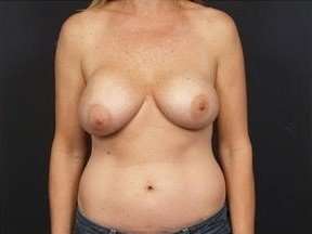 Breast Implant Revision Replacement Before & After Patient #364