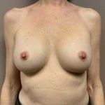 Breast Implant Revision Replacement Before & After Patient #389