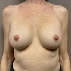 Breast Implant Revision Replacement Before & After Patient #389