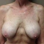 Breast Implant Revision Replacement Before & After Patient #404