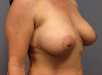 Breast Implant Revision Replacement Before & After Patient #407