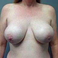 Breast Implant Revision Replacement Before & After Patient #417