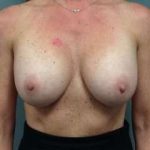 Breast Implant Revision Replacement Before & After Patient #430