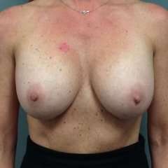 Breast Implant Revision Replacement Before & After Patient #430