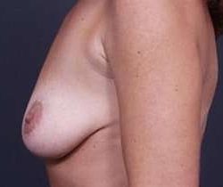Breast Mastopexy Before & After Patient #98