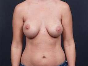 Breast Implant Revision Replacement Before & After Patient #451