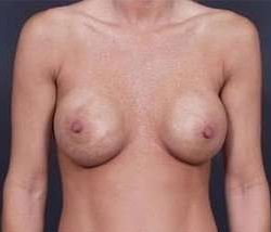 Breast Implant Revision Replacement Before & After Patient #454