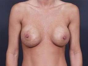 Breast Implant Revision Replacement Before & After Patient #454