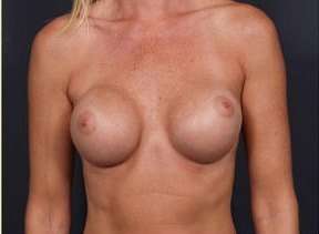 Breast Implant Revision Replacement Before & After Patient #459