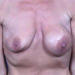 Breast Implant Revision Replacement Before & After Patient #482