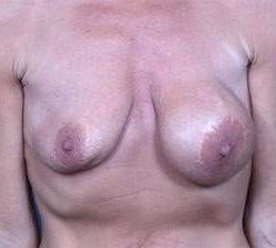 Breast Implant Revision Replacement Before & After Patient #482