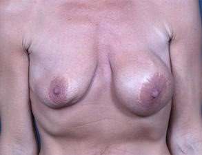 Breast Implant Revision Replacement Before & After Patient #482