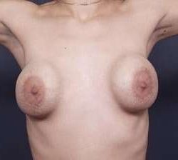 Breast Implant Revision Replacement Before & After Patient #489