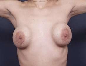 Breast Implant Revision Replacement Before & After Patient #489