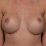 Breast Implant Revision Replacement Before & After Patient #496