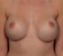 Breast Implant Revision Replacement Before & After Patient #496