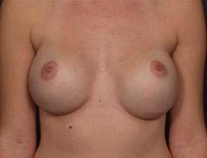 Breast Implant Revision Replacement Before & After Patient #496