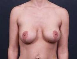 Breast Implant Revision Replacement Before & After Patient #508
