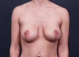 Breast Implant Revision Replacement Before & After Patient #508