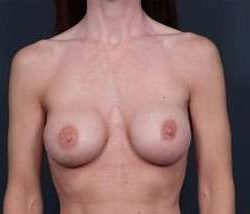 Breast Implant Revision Replacement Before & After Patient #515