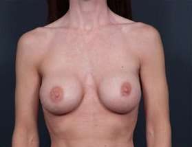 Breast Implant Revision Replacement Before & After Patient #515