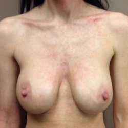 Breast Implant Revision Replacement Before & After Patient #523