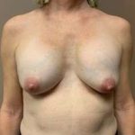 Breast Implant Revision Replacement Before & After Patient #573