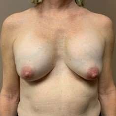Breast Implant Revision Replacement Before & After Patient #573