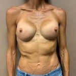 Breast Implant Revision Replacement Before & After Patient #580