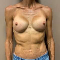Breast Implant Revision Replacement Before & After Patient #580