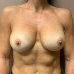 Breast Implant Revision Replacement Before & After Patient #585