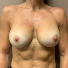 Breast Implant Revision Replacement Before & After Patient #585