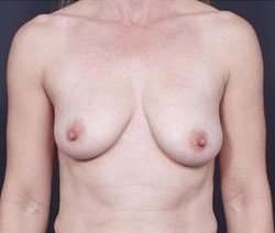 Breast Donut Mastopexy Before & After Patient #602