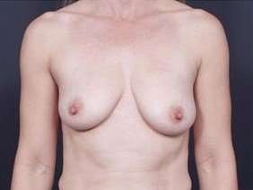 Breast Donut Mastopexy Before & After Patient #602