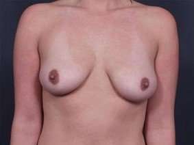 Breast Donut Mastopexy Before & After Patient #605