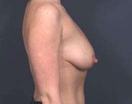 Breast Mastopexy Before & After Patient #136