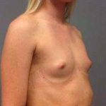 Breast Augmentation Before & After Patient #706
