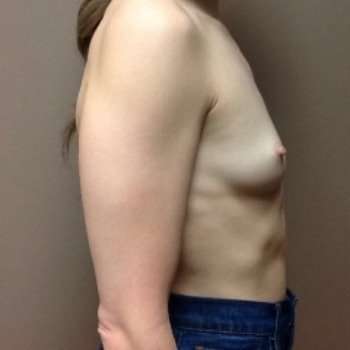 Breast Augmentation Before & After Patient #716