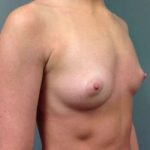 Breast Augmentation Before & After Patient #735