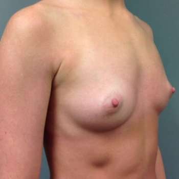 Breast Augmentation Before & After Patient #735