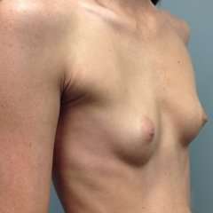 Breast Augmentation Before & After Patient #751