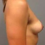 Breast Augmentation Before & After Patient #758