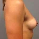 Breast Augmentation Before & After Patient #758