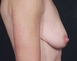 Breast Mastopexy Before & After Patient #141